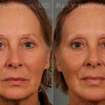 Laser Lift Precision Tx Before and After Photos in Montvale, NJ, Patient 13295