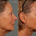 Laser Lift Precision Tx Before and After Photos in Montvale, NJ, Patient 13295