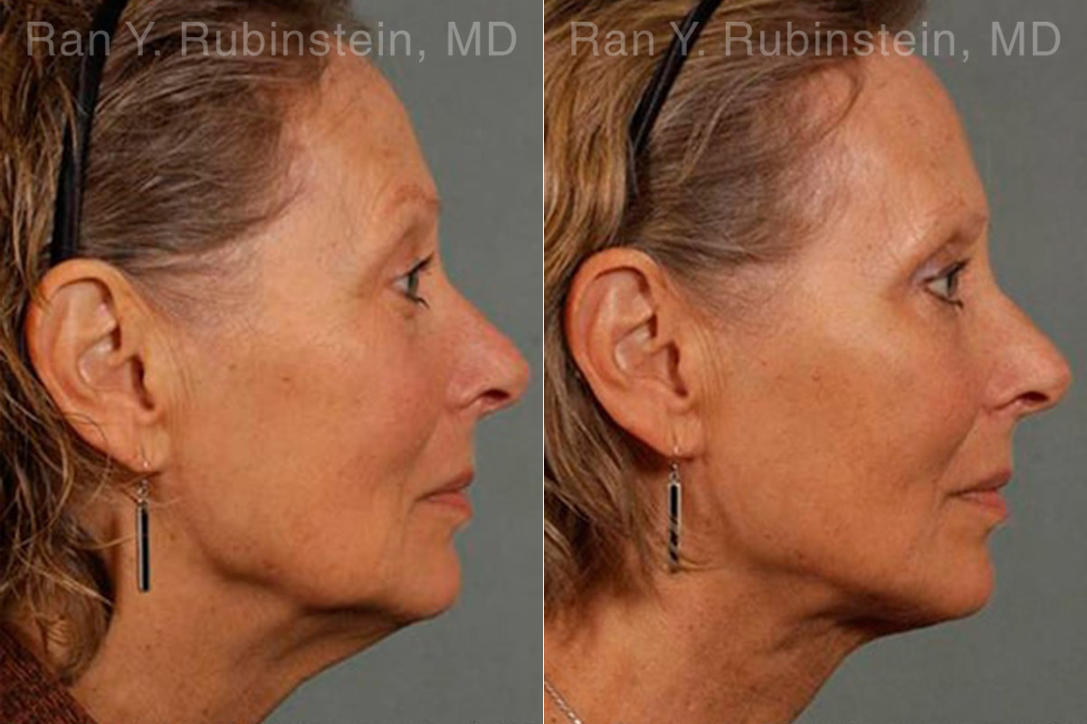 Laser Lift Precision Tx Before and After Photos in Montvale, NJ, Patient 13295