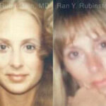 Laser Lift Precision Tx Before and After Photos in Montvale, NJ, Patient 13295