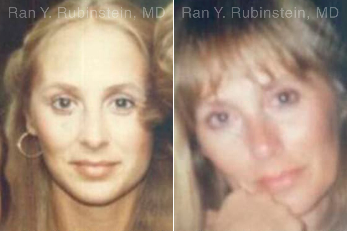 Laser Lift Precision Tx Before and After Photos in Montvale, NJ, Patient 13295