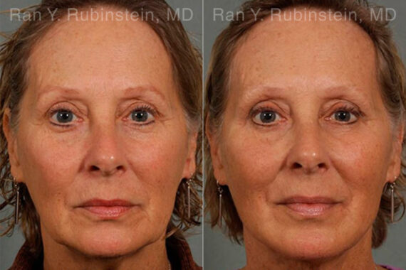 Laser Lift Precision Tx Before and After Photos in Montvale, NJ, Patient 13295