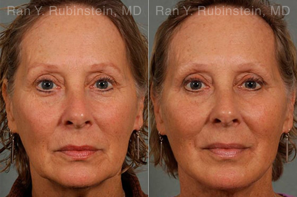 Laser Lift Precision Tx Before and After Photos in Montvale, NJ, Patient 13295