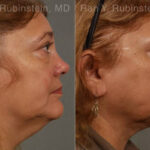Laser Lift Precision Tx Before and After Photos in Montvale, NJ, Patient 13304