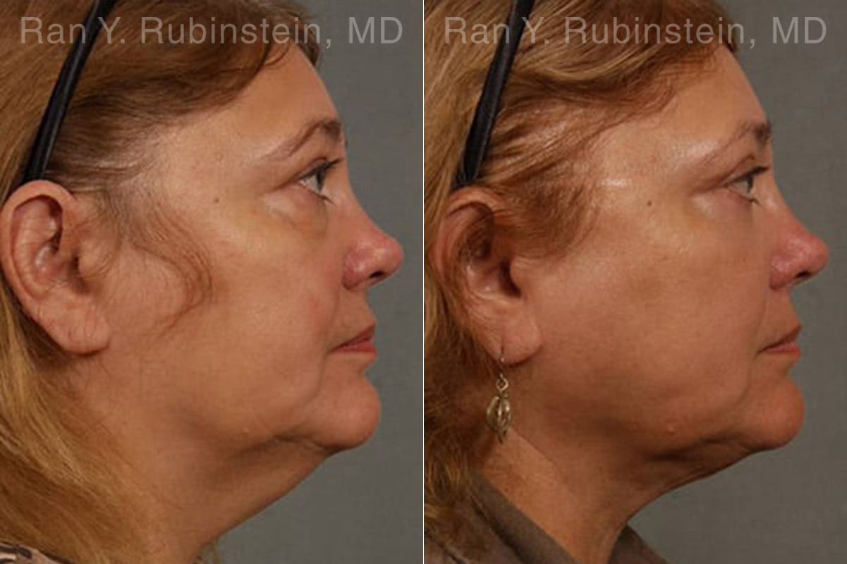 Laser Lift Precision Tx Before and After Photos in Montvale, NJ, Patient 13304