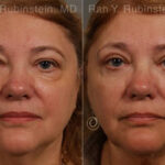 Laser Lift Precision Tx Before and After Photos in Montvale, NJ, Patient 13304