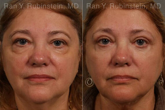 Laser Lift Precision Tx Before and After Photos in Montvale, NJ, Patient 13304