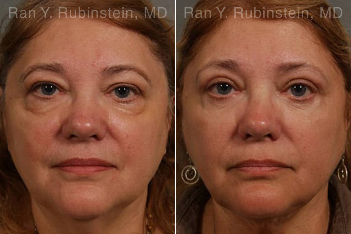Laser Lift Precision Tx Before and After Photos in Montvale, NJ, Patient 13304