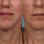 Face lift & Neck lift Before and After Photos in Montvale, NJ, Patient 22168
