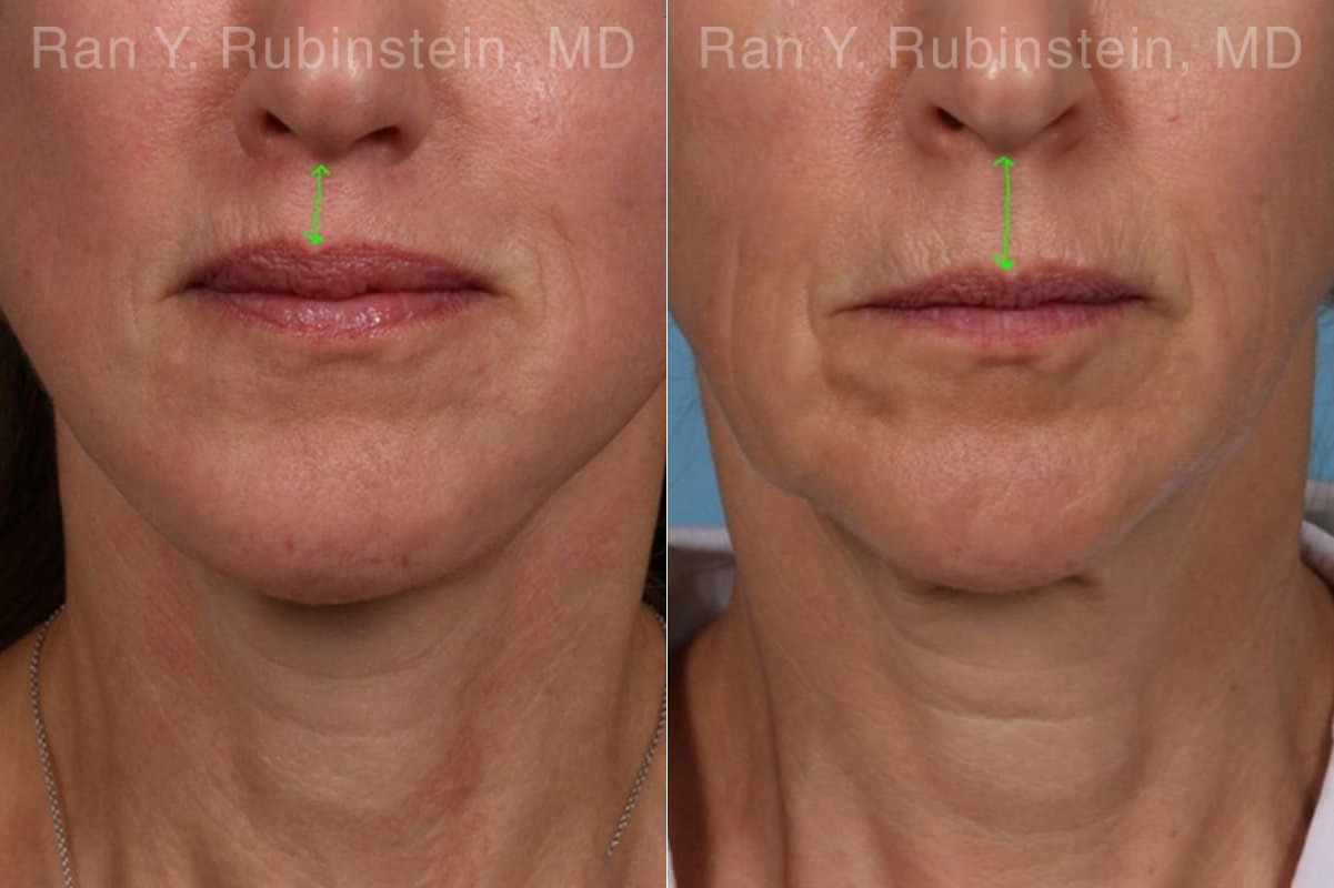 Face lift & Neck lift Before and After Photos in Montvale, NJ, Patient 22168