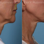 Lip Lift Before and After Photos in Montvale, NJ, Patient 22196
