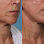 Lip Lift Before and After Photos in Montvale, NJ, Patient 22196