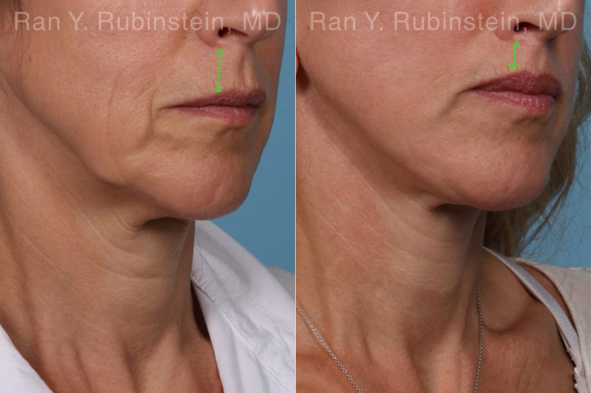 Lip Lift Before and After Photos in Montvale, NJ, Patient 22196