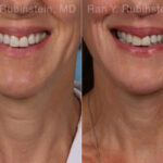 Lip Lift Before and After Photos in Montvale, NJ, Patient 22196
