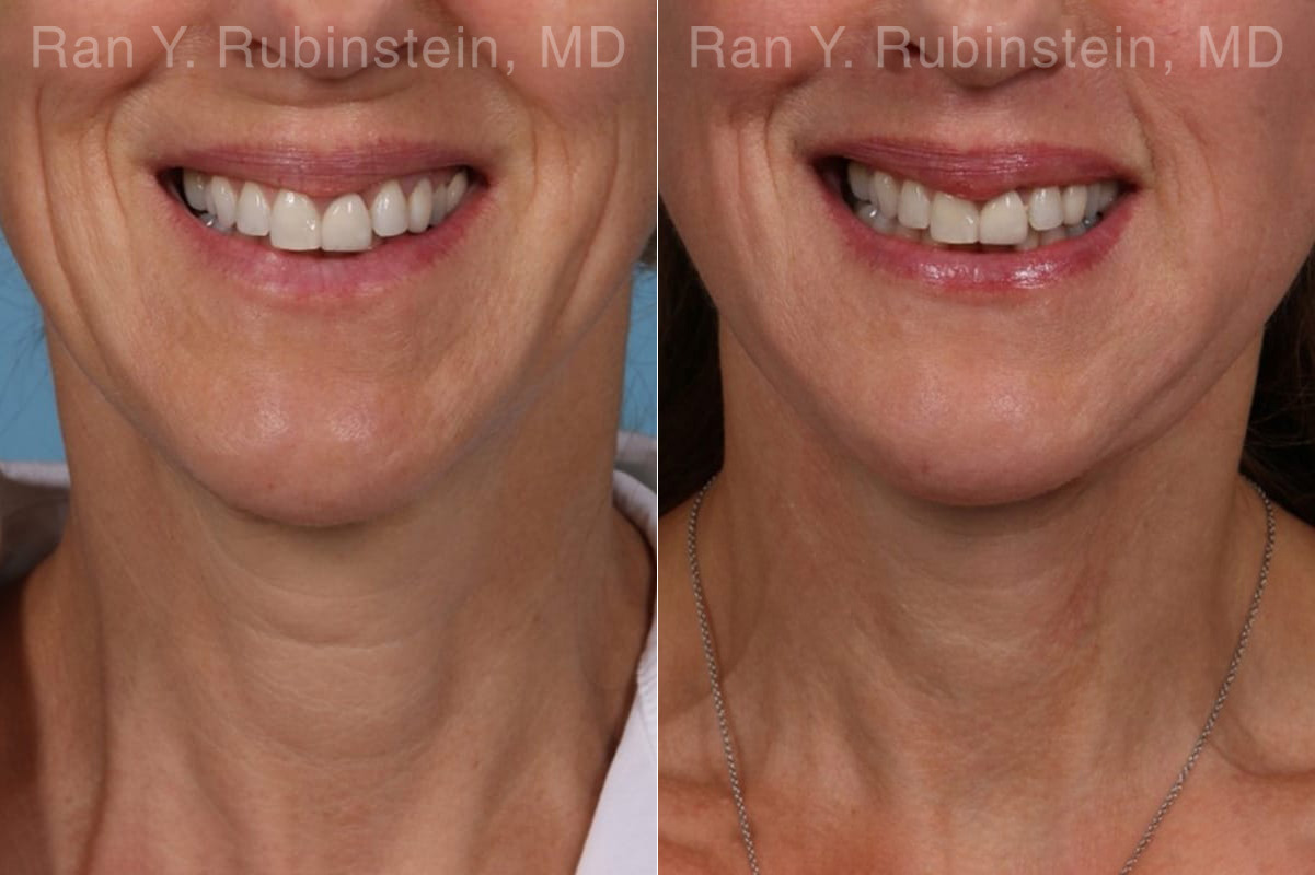 Lip Lift Before and After Photos in Montvale, NJ, Patient 22196