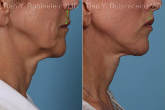Lip Lift Before and After Photos in Montvale, NJ, Patient 22196