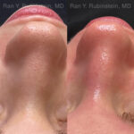HydraFacial Before and After Photos in Montvale, NJ, Patient 23011