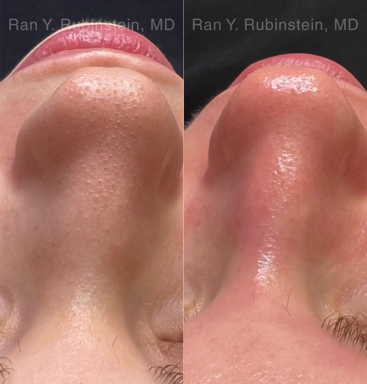 HydraFacial Before and After Photos in Montvale, NJ, Patient 23011