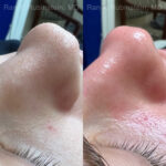 HydraFacial Before and After Photos in Montvale, NJ, Patient 23011