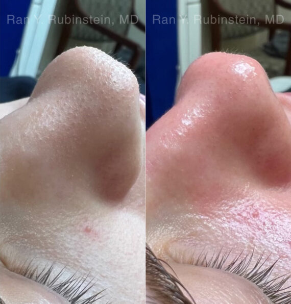 HydraFacial Before and After Photos in Montvale, NJ, Patient 23011
