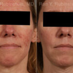 Laser Treatments Before and After Photos in Montvale, NJ, Patient 23709