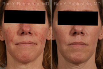 Laser Treatments Before and After Photos in Montvale, NJ, Patient 23709
