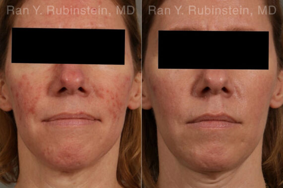 Laser Treatments Before and After Photos in Montvale, NJ, Patient 23709