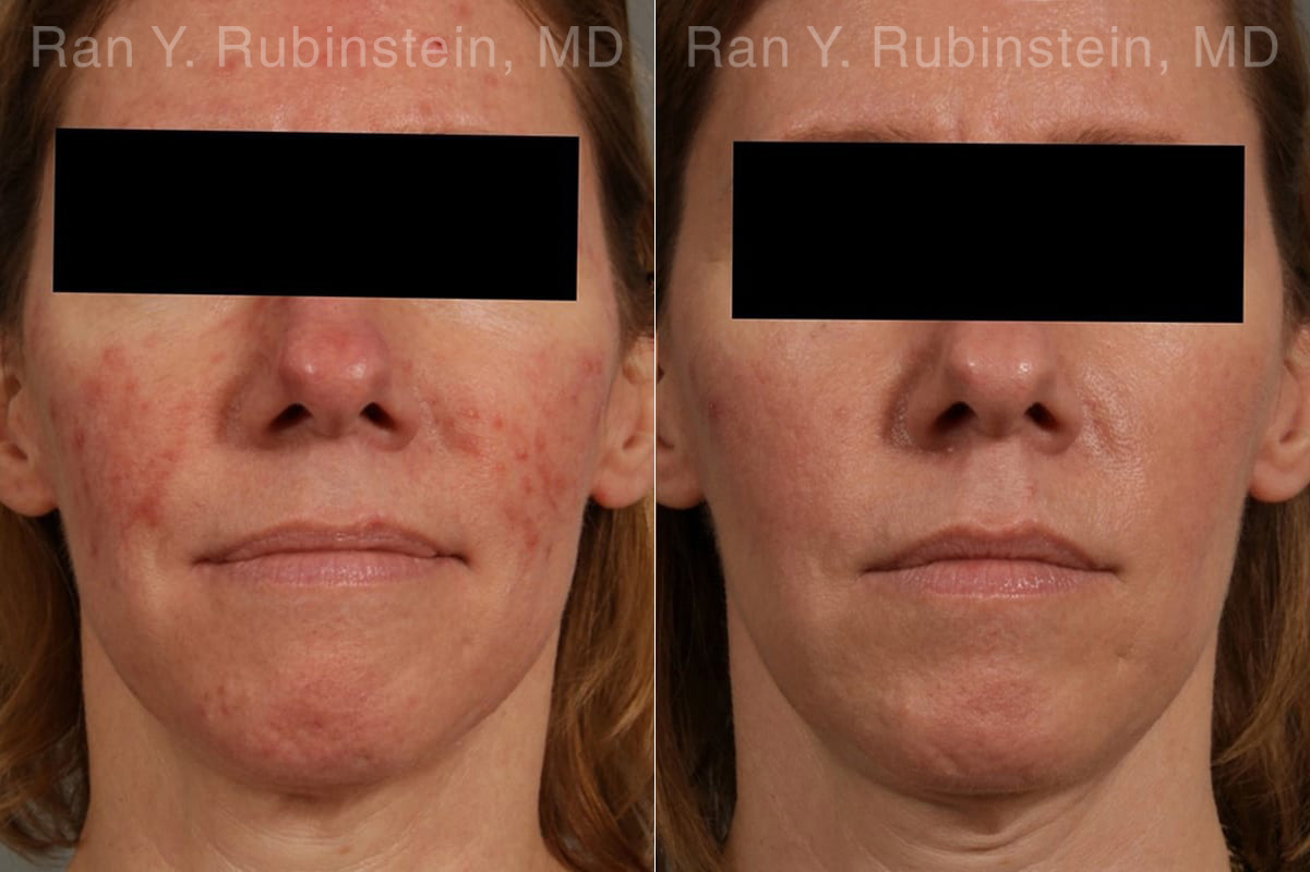 Laser Treatments Before and After Photos in Montvale, NJ, Patient 23709