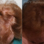 PRP Hair Restoration Before and After Photos in Montvale, NJ, Patient 23736