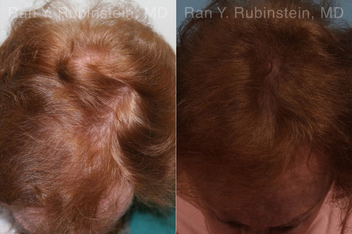 PRP Hair Restoration Before and After Photos in Montvale, NJ, Patient 23736