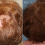 PRP Hair Restoration Before and After Photos in Montvale, NJ, Patient 23736