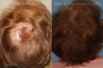 PRP Hair Restoration Before and After Photos in Montvale, NJ, Patient 23736