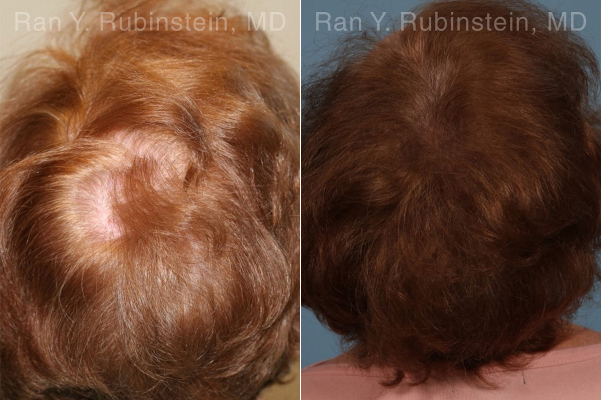 PRP Hair Restoration Before and After Photos in Montvale, NJ, Patient 23736