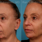 Dermal Fillers Before and After Photos in Montvale, NJ, Patient 24382