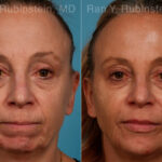 Dermal Fillers Before and After Photos in Montvale, NJ, Patient 24382