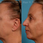 Dermal Fillers Before and After Photos in Montvale, NJ, Patient 24382