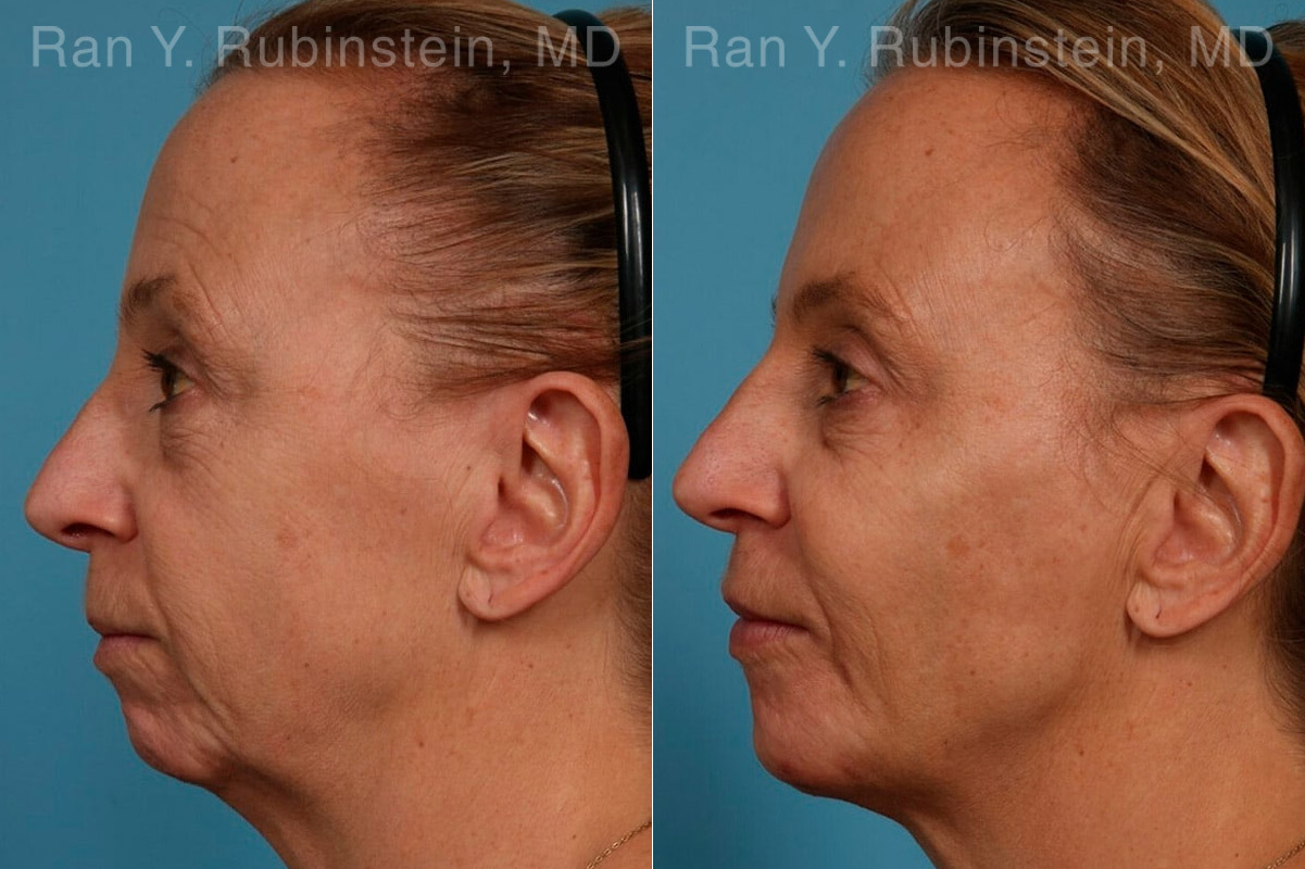 Dermal Fillers Before and After Photos in Montvale, NJ, Patient 24382