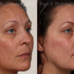 Peels & Microdermabrasion Before and After Photos in Montvale, NJ, Patient 26247