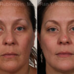 Peels & Microdermabrasion Before and After Photos in Montvale, NJ, Patient 26247