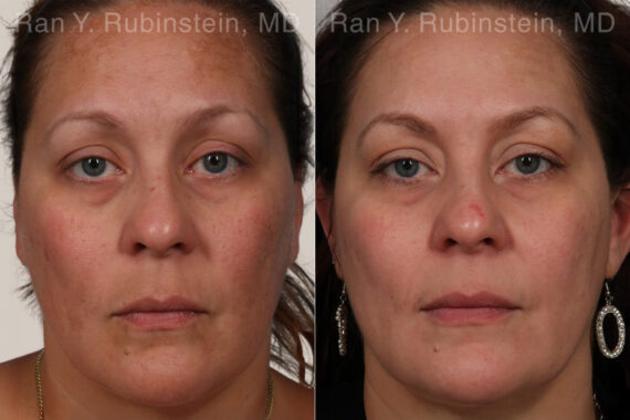 Peels & Microdermabrasion Before and After Photos in Montvale, NJ, Patient 26247