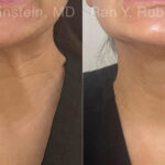 Botox Before and After Photos in Montvale, NJ, Patient 30492