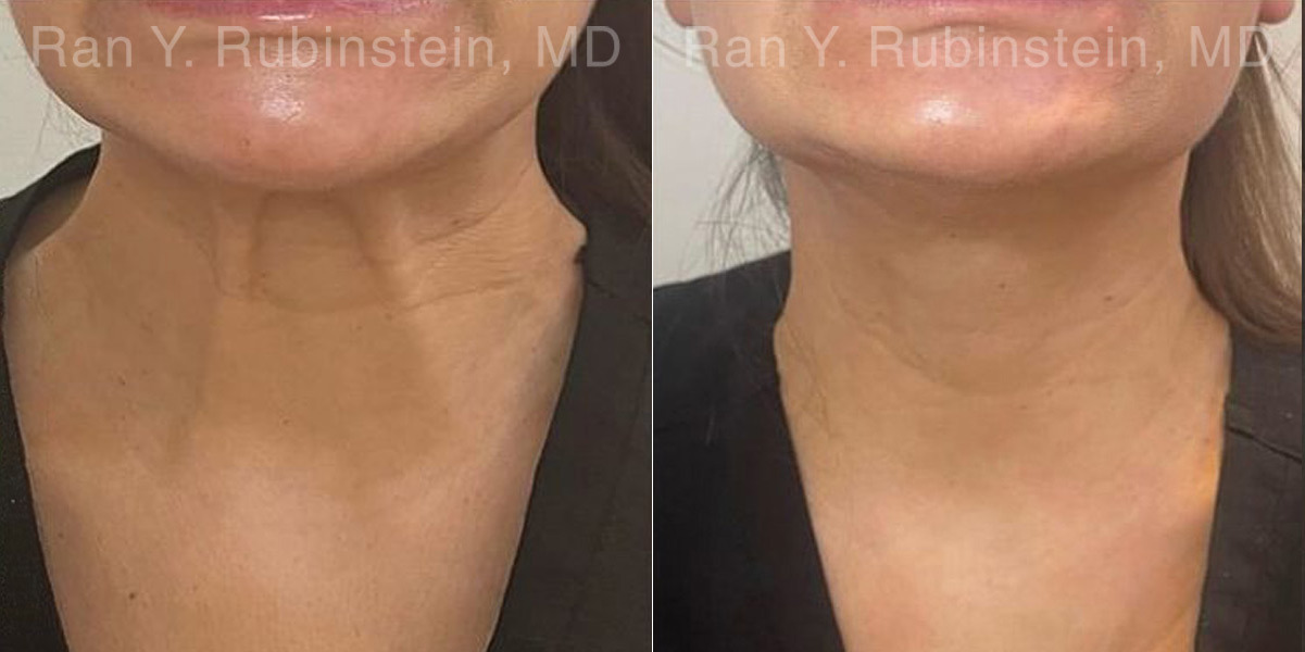Botox Before and After Photos in Montvale, NJ, Patient 30492