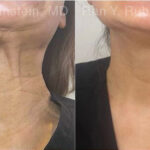 Botox Before and After Photos in Montvale, NJ, Patient 30492