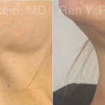 Botox Before and After Photos in Montvale, NJ, Patient 30492