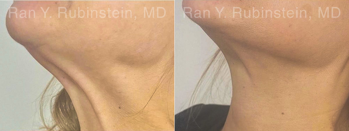 Botox Before and After Photos in Montvale, NJ, Patient 30492