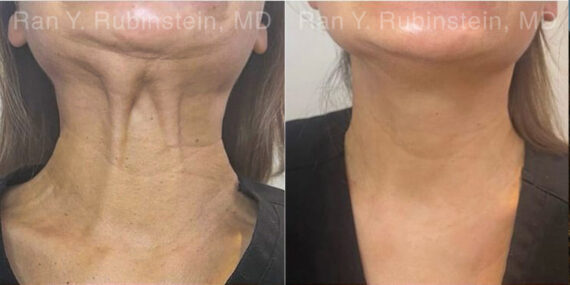 Botox Before and After Photos in Montvale, NJ, Patient 30492