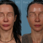 Sculptra Face Before and After Photos in Montvale, NJ, Patient 30699