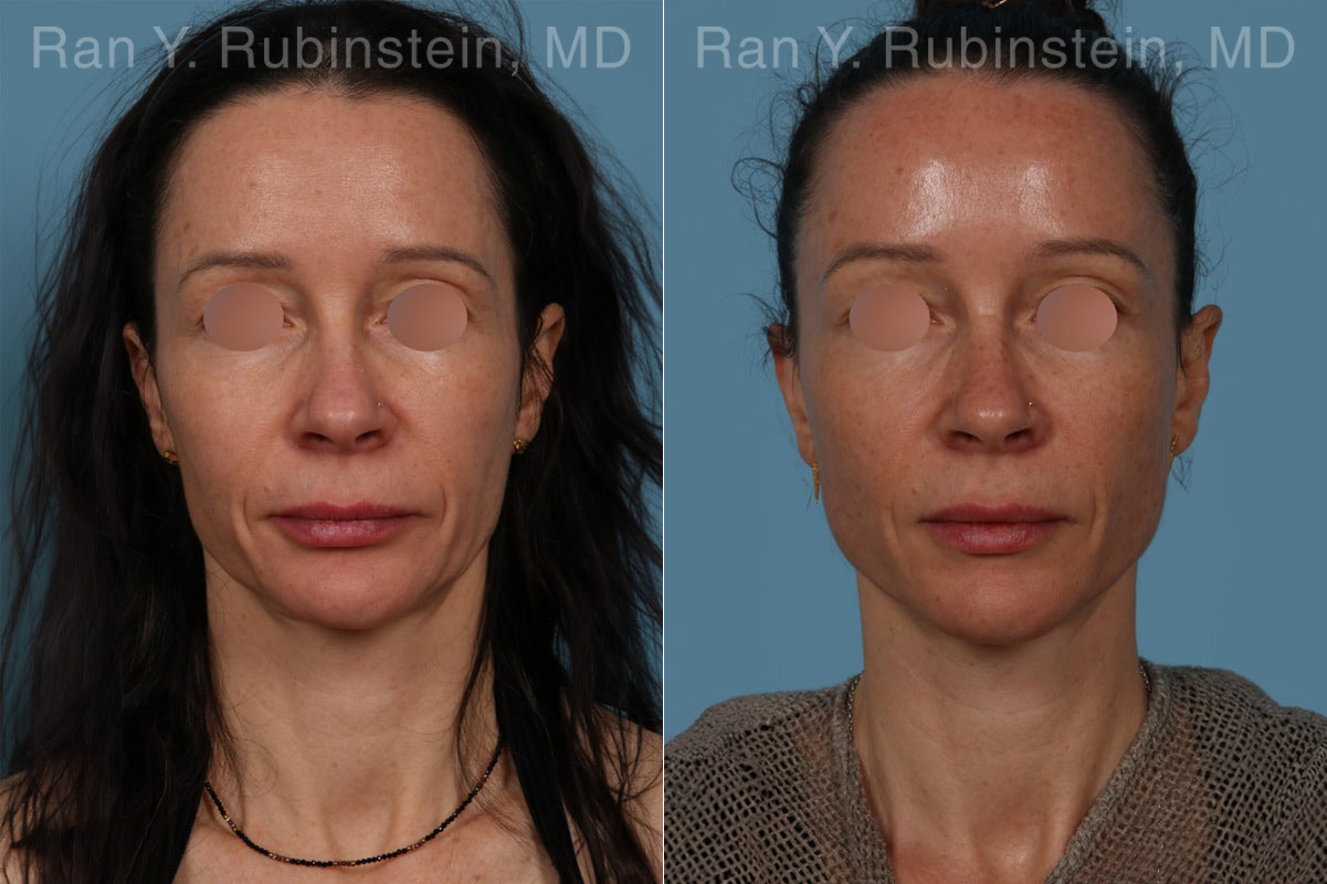 Sculptra Face Before and After Photos in Montvale, NJ, Patient 30699