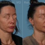 Sculptra Face Before and After Photos in Montvale, NJ, Patient 30699