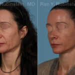 Sculptra Face Before and After Photos in Montvale, NJ, Patient 30699